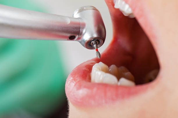Best Emergency Dentist for Lost Fillings or Crowns in Jonesville, NC